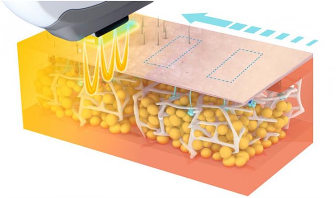 Schnelle Haar-Abbau-Laser-Maschine Dauerhaftes IPLs SHR für Epidermis-Tupfen